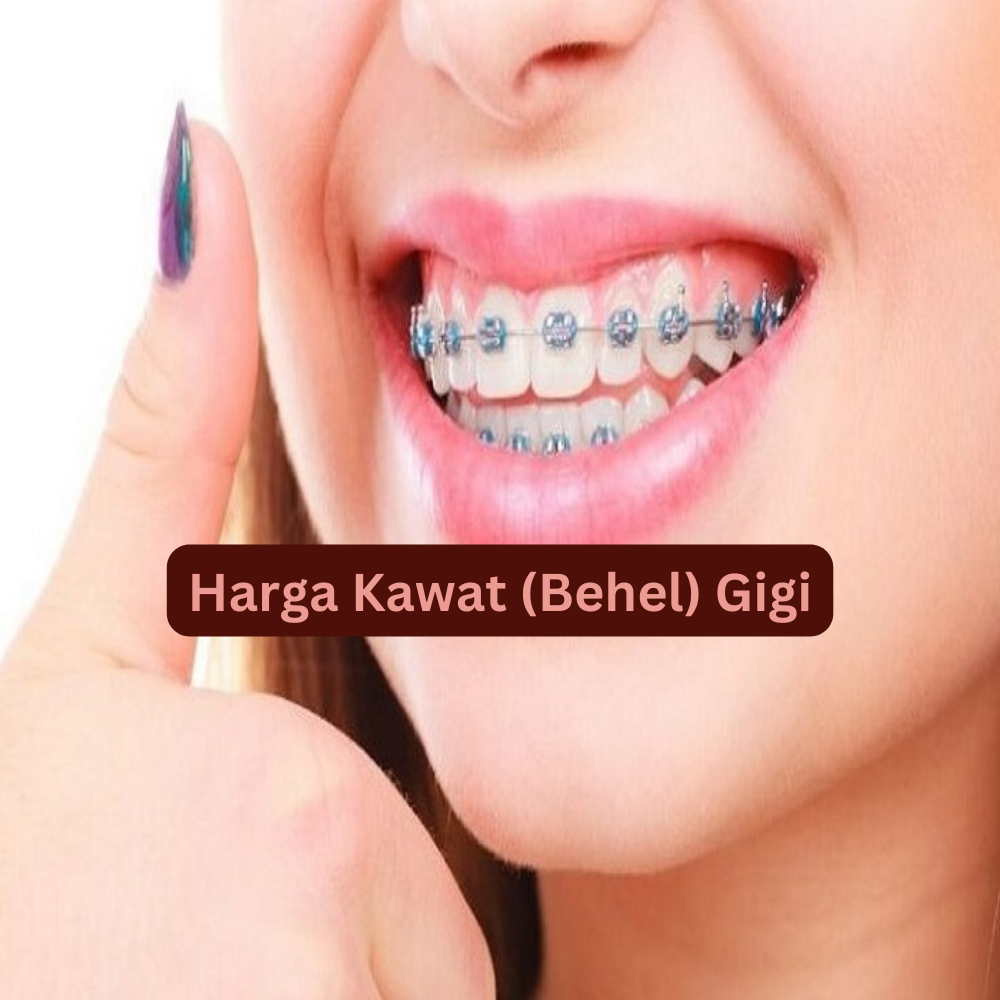 Harga Kawat (Behel) Gigi